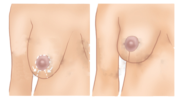 1451986666658633.jpg 提乳手術1.jpg