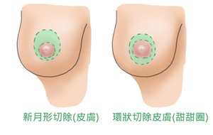 1451986671732652.jpg 提乳手術2.jpg