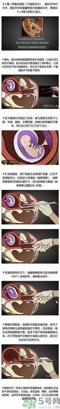 墮胎手術的可怕細節