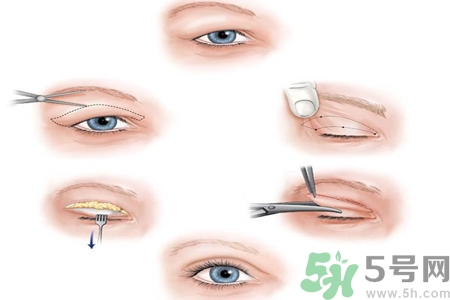 割雙眼皮分哪幾種？割雙眼皮需要多少錢？