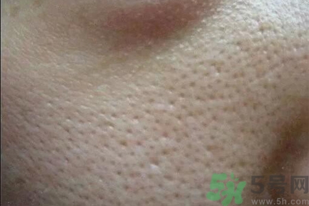 皮膚毛孔粗大原因有哪些？如何預防皮膚毛孔粗大？