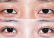 割雙眼皮分哪幾種？割雙眼皮需要多少錢？