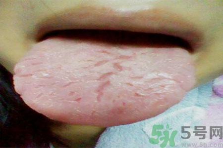 舌頭上有裂紋是怎么辦？舌頭上有裂紋是什么原因？