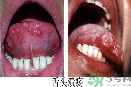 舌頭潰瘍怎么辦？舌頭潰瘍的原因？