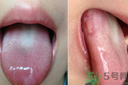 舌頭潰瘍怎么辦？舌頭潰瘍的原因？