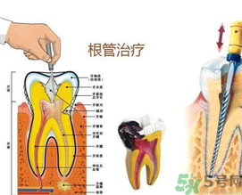 什么是根管治療？為什么牙齒疼要做根管治療？