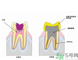 什么是根管治療？為什么牙齒疼要做根管治療？