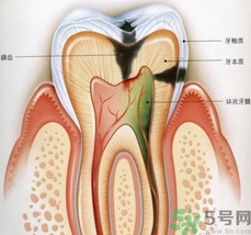 什么是根管治療？為什么牙齒疼要做根管治療？