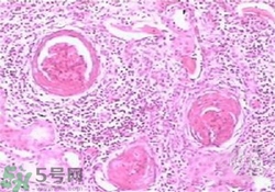 慢性腎炎能治好嗎？慢性腎炎能活多久？