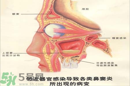 鼻竇炎是什么？鼻竇炎的癥狀有哪些？