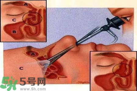 鼻竇炎的高發人群？如何預防鼻竇炎？