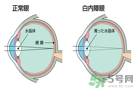 白內(nèi)障治療方法是什么？白內(nèi)障可以用什么藥物治療？