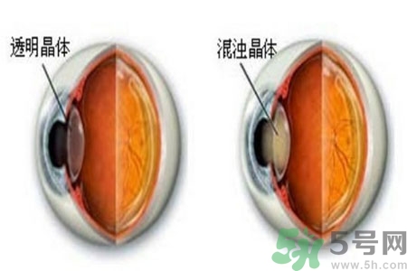 白內(nèi)障治療方法是什么？白內(nèi)障可以用什么藥物治療？