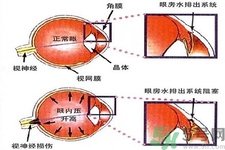 青光眼的發病因素是什么？青光眼的并發癥有哪些？