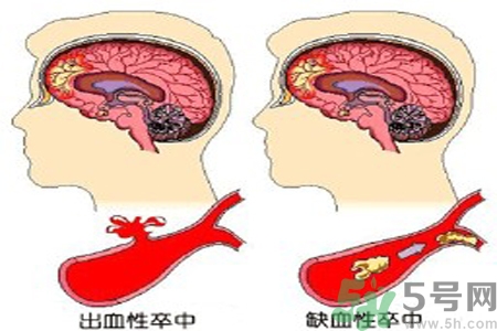 腦出血的治療方法是什么？腦出血可以用哪些藥物治療？