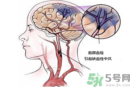 腦出血的治療方法是什么？腦出血可以用哪些藥物治療？