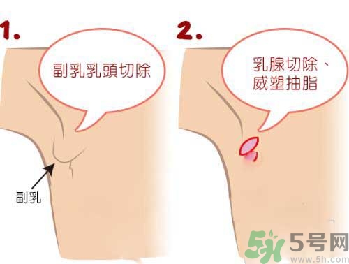 副乳是什么？副乳的危害