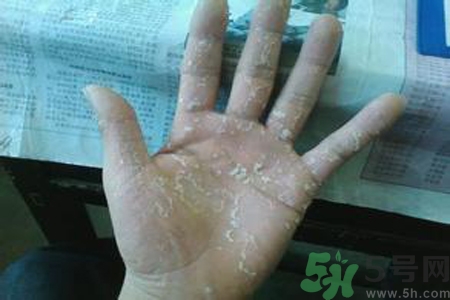 引起手足癬的主要原因？手足癬會引發(fā)什么疾病？
