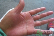 手足癬的易發(fā)人群有哪些？如何預(yù)防手足癬？