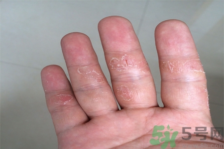 手足癬的易發(fā)人群有哪些？如何預(yù)防手足癬？