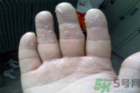 手足癬的易發(fā)人群有哪些？如何預(yù)防手足癬？