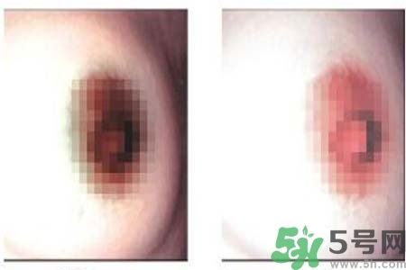 乳頭發黑怎么辦？怎么樣可以使乳頭變白？