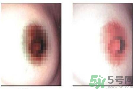 乳頭發黑是怎么回事？乳頭發黑是什么原因？