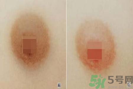 乳頭發黑是怎么回事？乳頭發黑是什么原因？