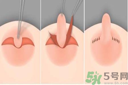 乳頭內陷怎么回事？乳頭內陷的原因是什么？
