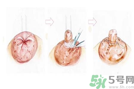 乳頭內陷怎么回事？乳頭內陷的原因是什么？