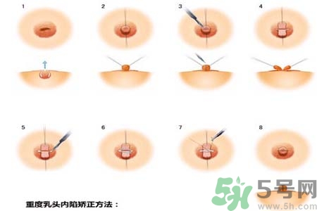 乳頭內陷怎么回事？乳頭內陷的原因是什么？