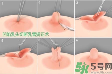 乳頭內陷怎么辦？乳頭內陷的癥狀有哪些？