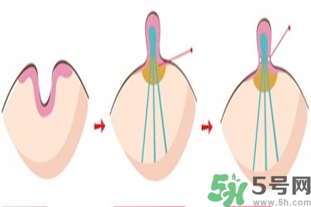 乳頭內陷怎么辦？乳頭內陷的癥狀有哪些？