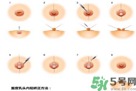 乳頭內陷怎么辦？乳頭內陷的癥狀有哪些？
