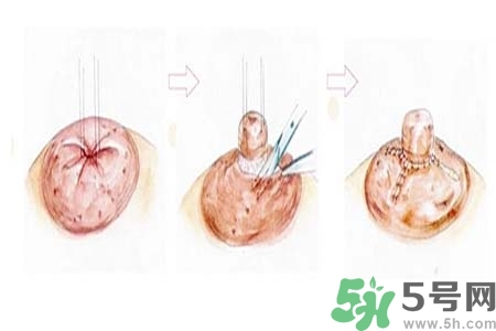 乳頭內陷怎么辦？乳頭內陷的癥狀有哪些？