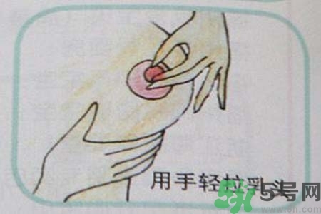 乳頭內陷怎么辦？乳頭內陷的癥狀有哪些？