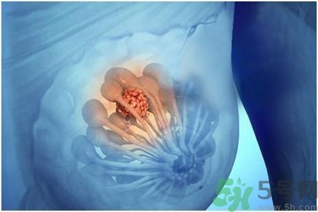 乳房有硬塊正常嗎？乳房有腫塊怎么回事？