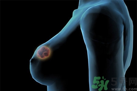 怎樣區分乳房包塊是良性還是惡性？如何診斷乳房腫塊是惡性還是良性？