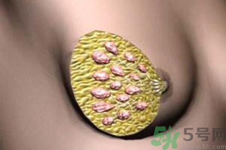 產生乳腺增生鈣化的病因是什么？乳腺增生怎樣治療？