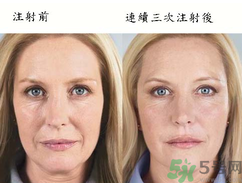 3D液態拉皮多少錢？3D液態拉皮后多久見效？