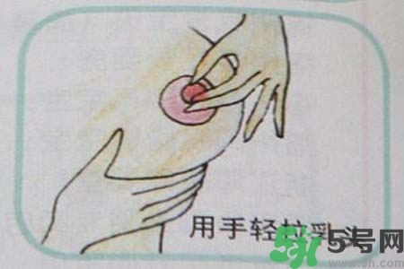 乳頭內陷怎么矯正？乳頭內陷矯正方法是什么？