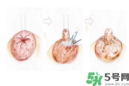 乳頭內陷怎么矯正？乳頭內陷矯正方法是什么？