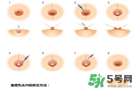 乳頭內陷怎么矯正？乳頭內陷矯正方法是什么？