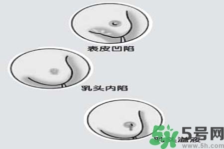 乳頭內陷怎么矯正？乳頭內陷矯正方法是什么？