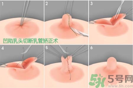 乳頭內陷怎么矯正？乳頭內陷矯正方法是什么？