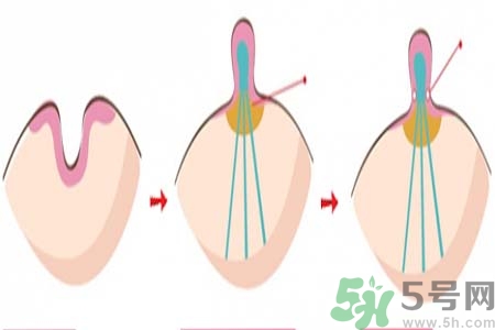 乳頭內陷矯正需注意什么？乳頭內陷如何預防？