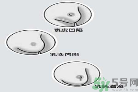 乳頭內陷矯正需注意什么？乳頭內陷如何預防？