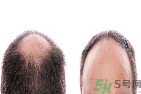 頭發稀少的原因是什么？如何預防禿頂的發生？