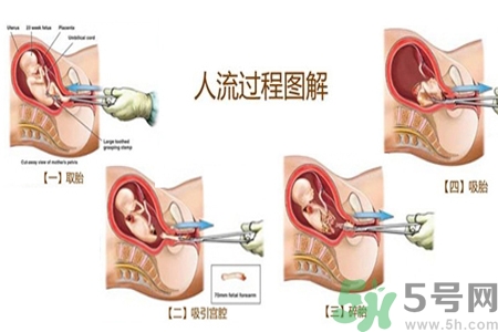 人工流產后多久可以再次懷孕？流產后需要注意什么？