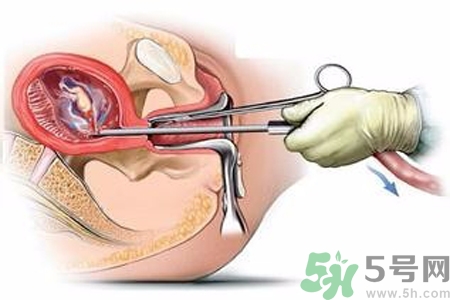 人工流產后多久可以再次懷孕？流產后需要注意什么？
